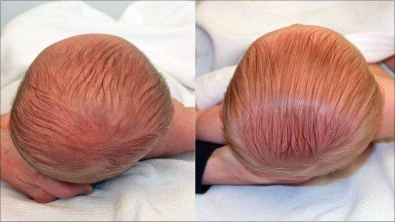 Dấu hiệu đầu bẹp ở trẻ sơ sinh: Đầu bé ngắn và rộng