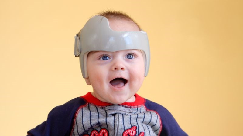 Mẹo chữa bẹp đầu cho trẻ sơ sinh: Đội mũ bảo hiểm điều chỉnh