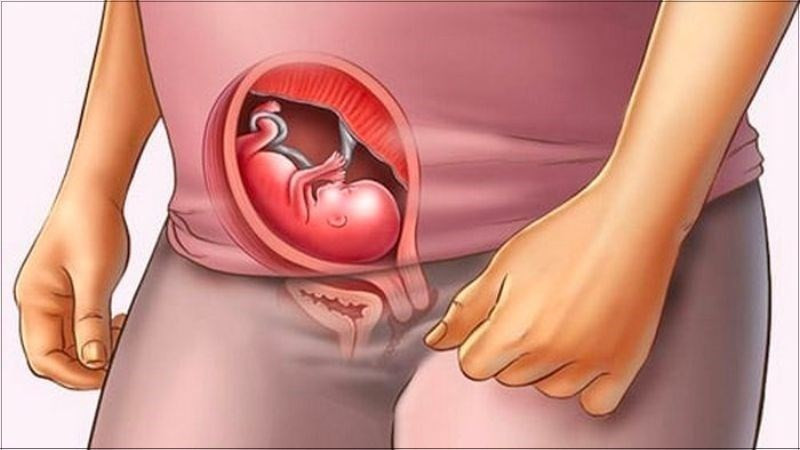 Nguyên nhân đầu bẹp ở trẻ sơ sinh: Vị trí trong bụng mẹ